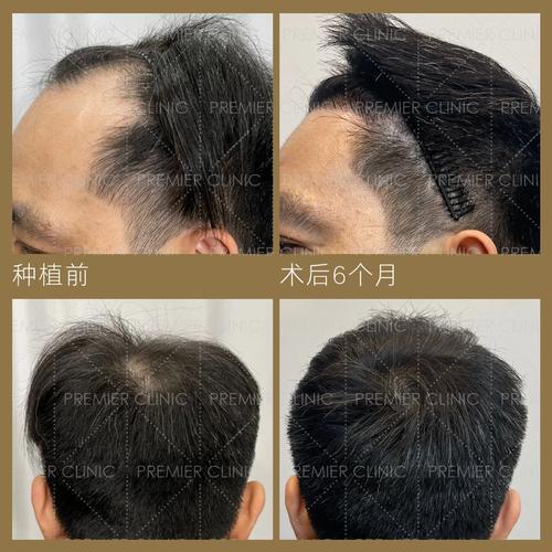 无痕植发海峡植发安全