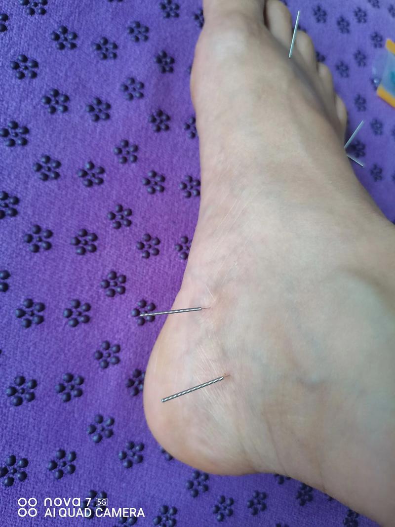 皮肤瘙痒的针灸治疗