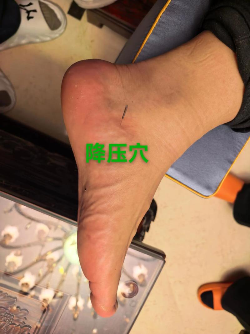 针灸按摩治疗高血压