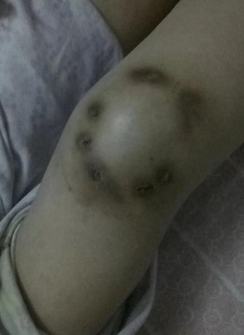 针灸后感染什么症状