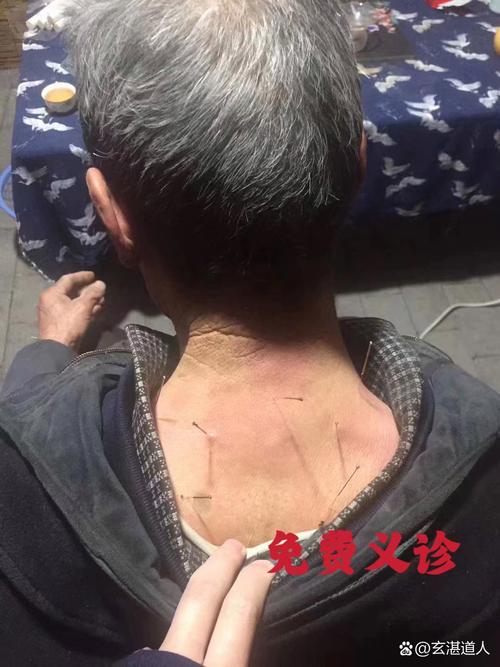 针灸后感染什么症状