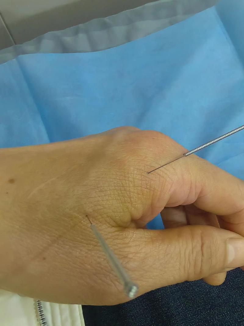 针灸几次湿疹能不痒