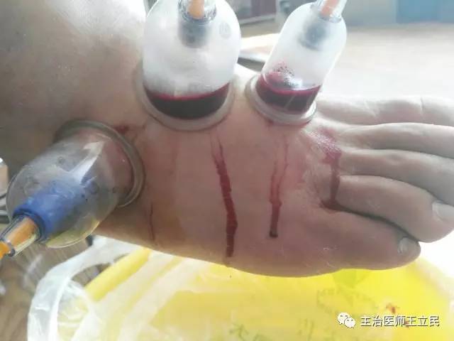 痛风放血疗法的利与弊