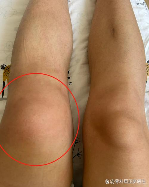 痛风膝盖肿胀怎么消除