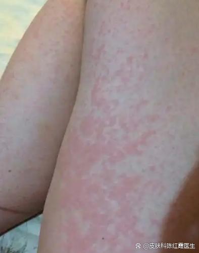 女性对安全套过敏症状