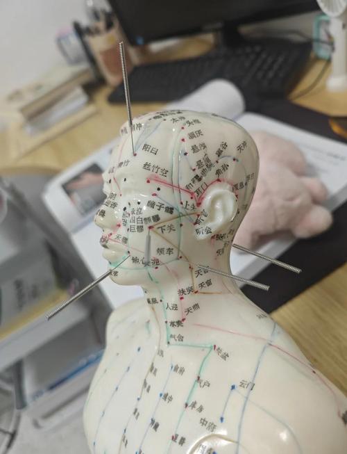 怀孕面瘫可以针灸吗