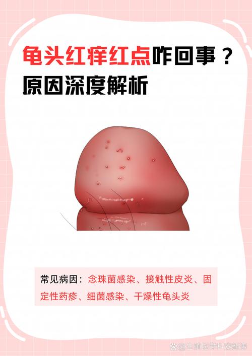 龟头对安全套过敏症状