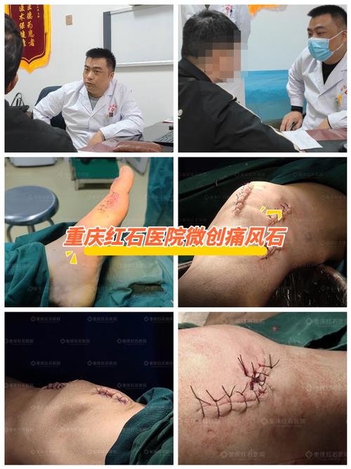 重庆痛风医院九五优先