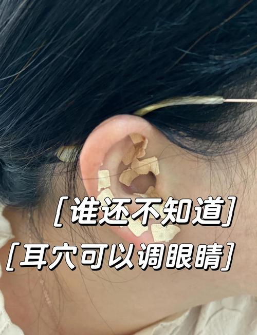 针灸治疗耳聋的穴位