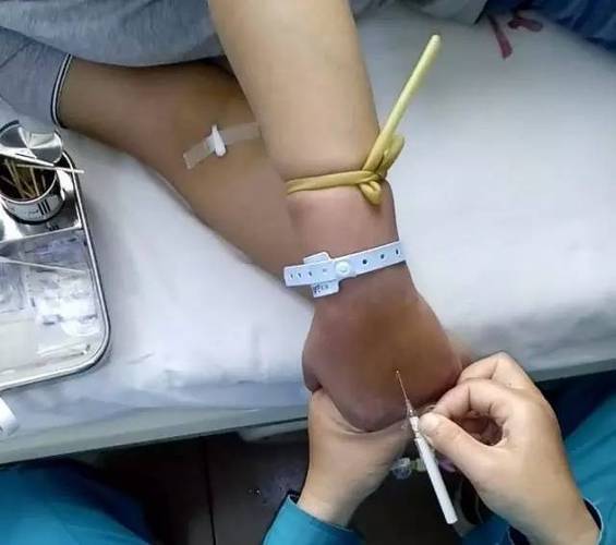 针灸套管针进针视频