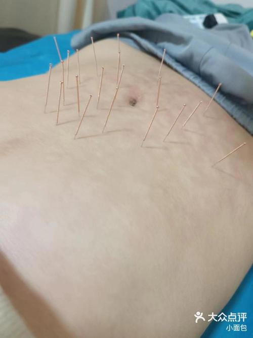 开封针灸减肥哪里好