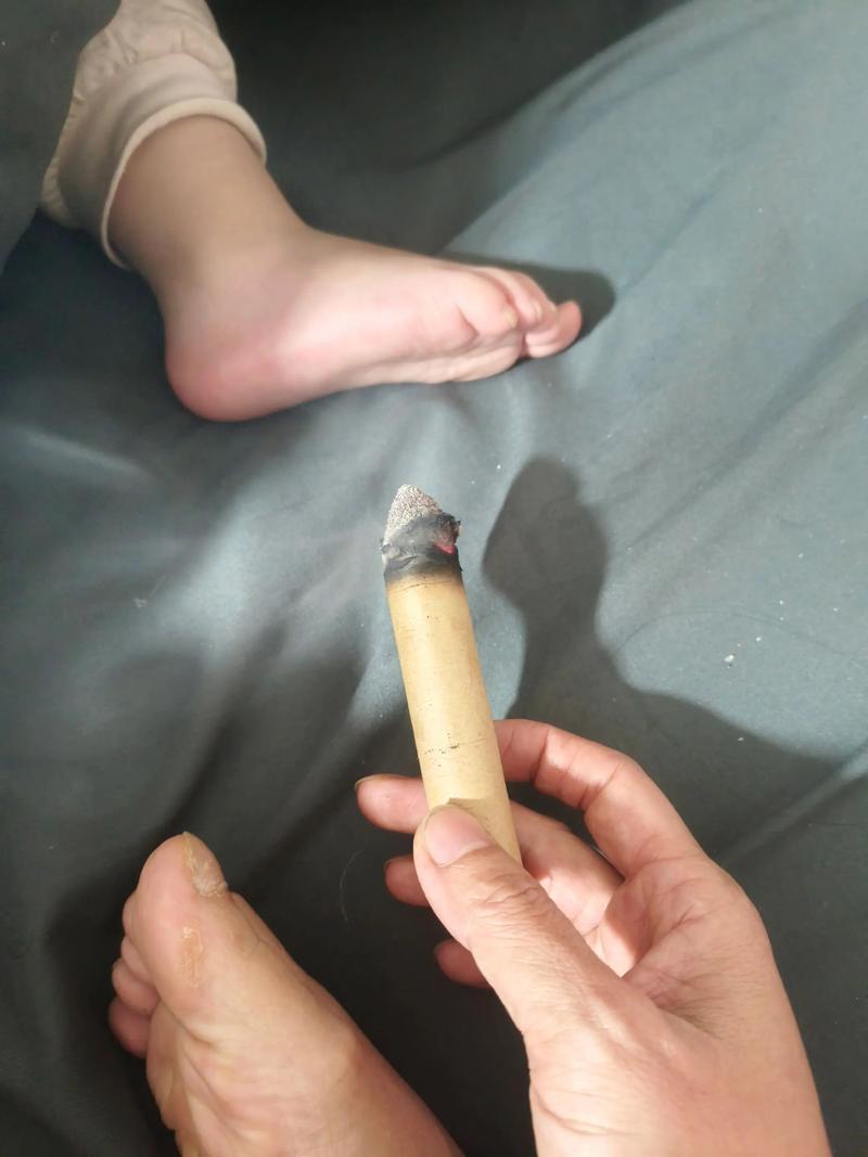 孩子咳嗽可以针灸吗