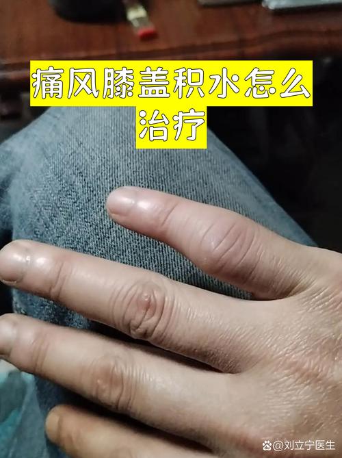 膝盖痛风如何快速消肿