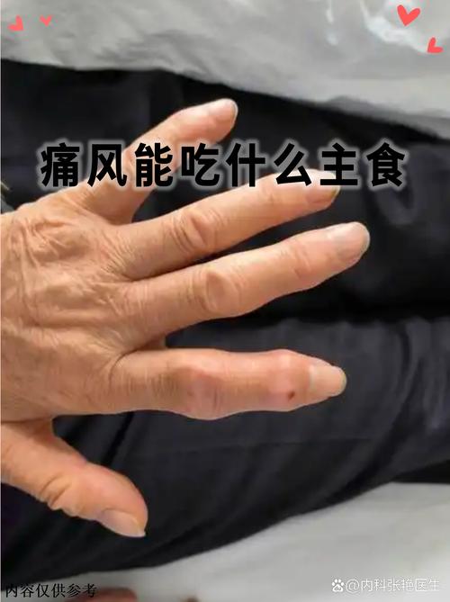 患了痛风会有哪些症状