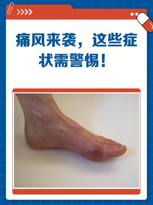 患了痛风会有哪些症状