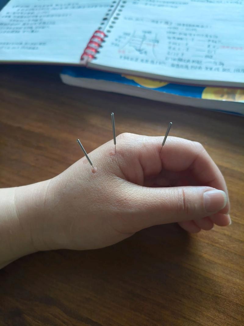 自己可以针灸扎针吗