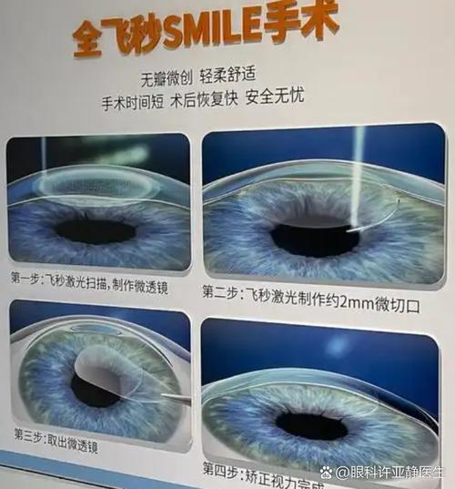 激光手术近视眼安全吗