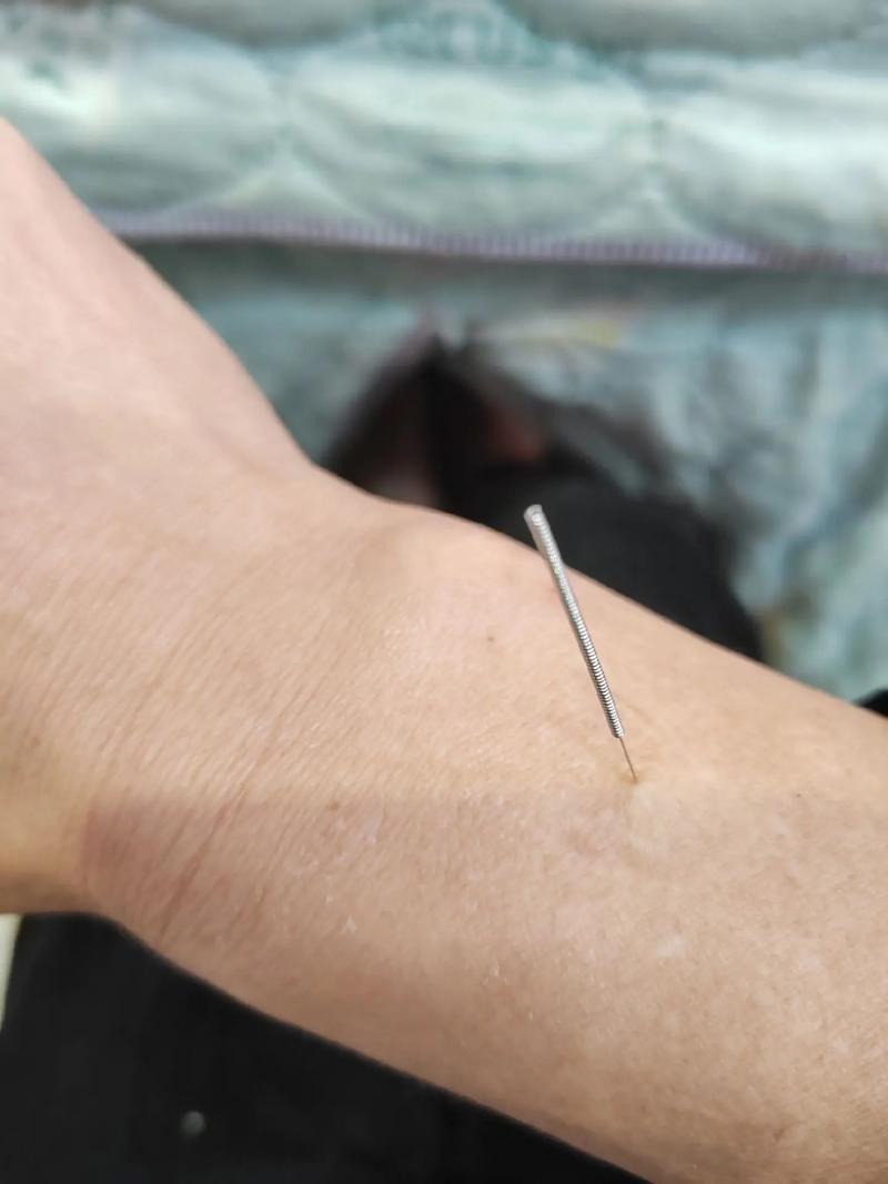 针灸好了后又回去了