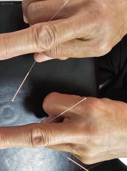 针灸好了后又回去了