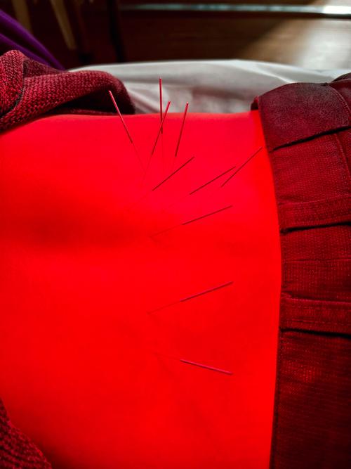 腰部扭伤可以针灸吗