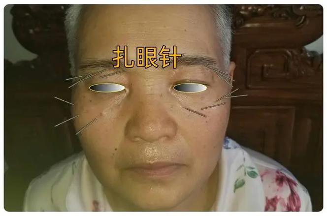 眼部针灸后视力模糊