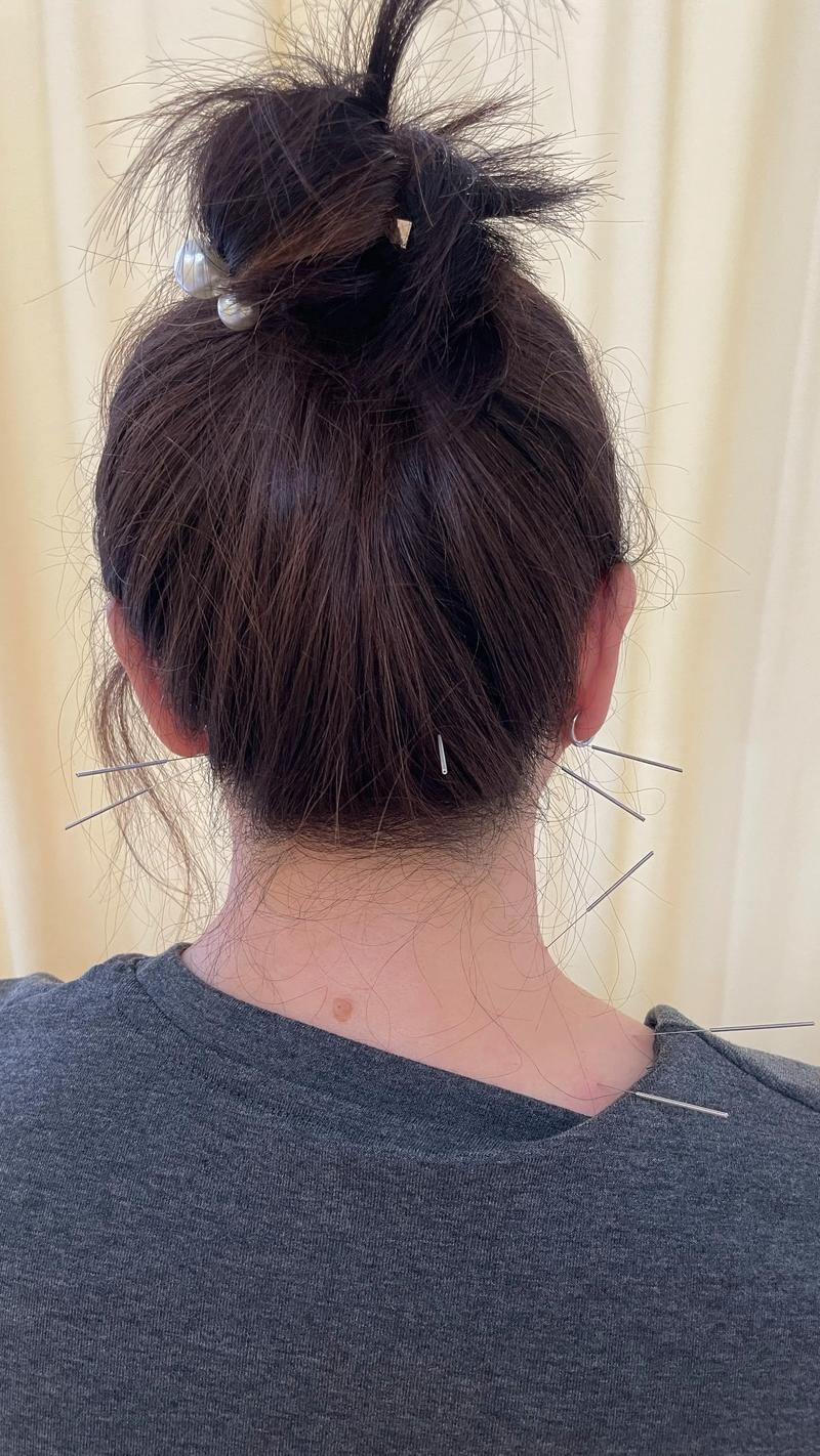 针灸治疗女性性冷淡