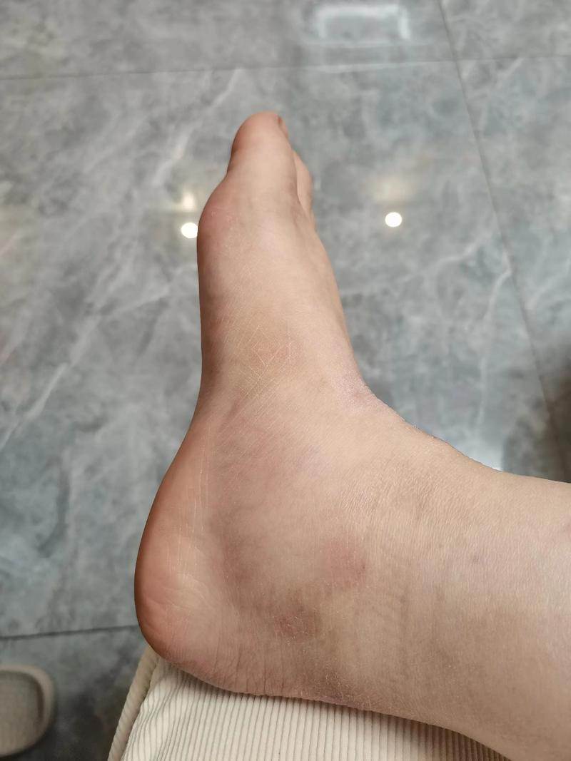 女性初期痛风症状图片