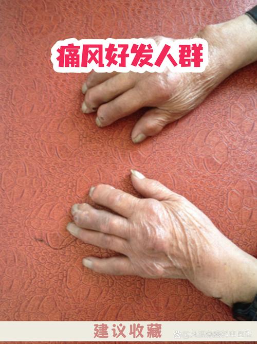 尿酸430会出现痛风