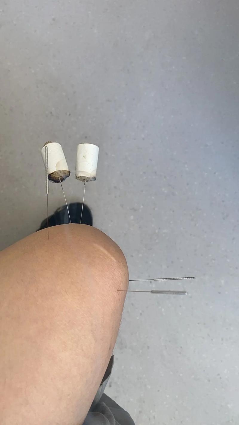 腿疼 扎针灸管用吗
