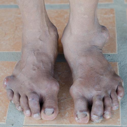 痛风多久会形成痛风石