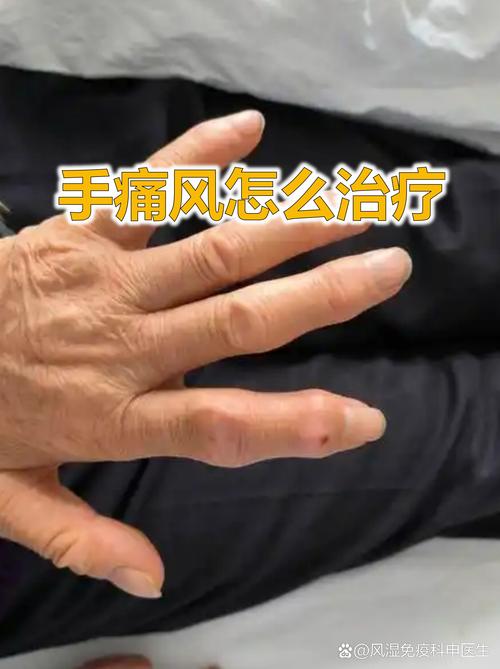 年轻人第一次痛风发作