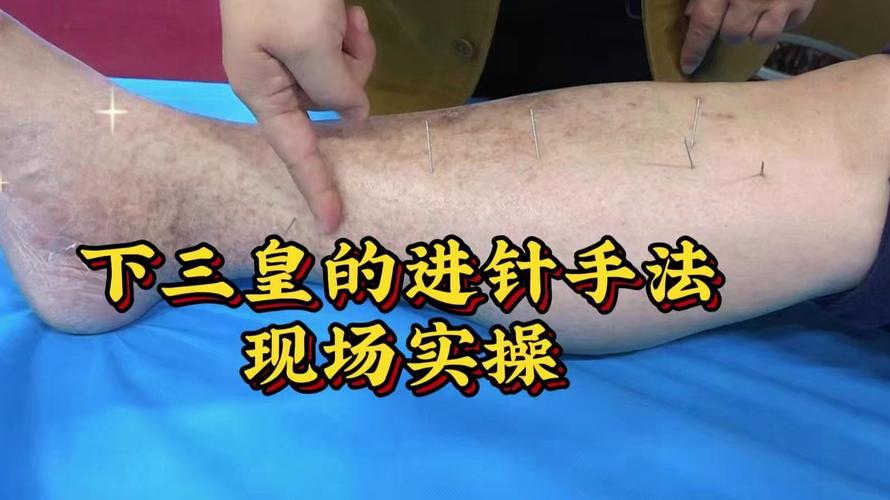 合肥哪里可以学针灸