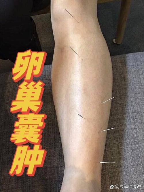 针灸治右侧附件囊肿