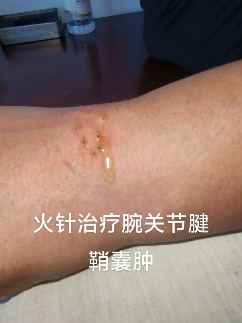 针灸治右侧附件囊肿