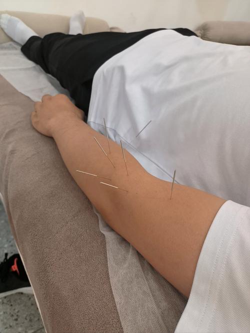 甲状腺肿大针灸治疗