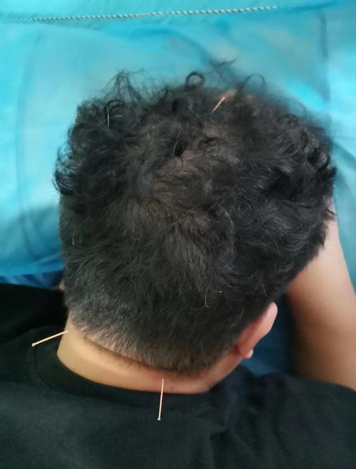 脖子扭伤可以针灸吗