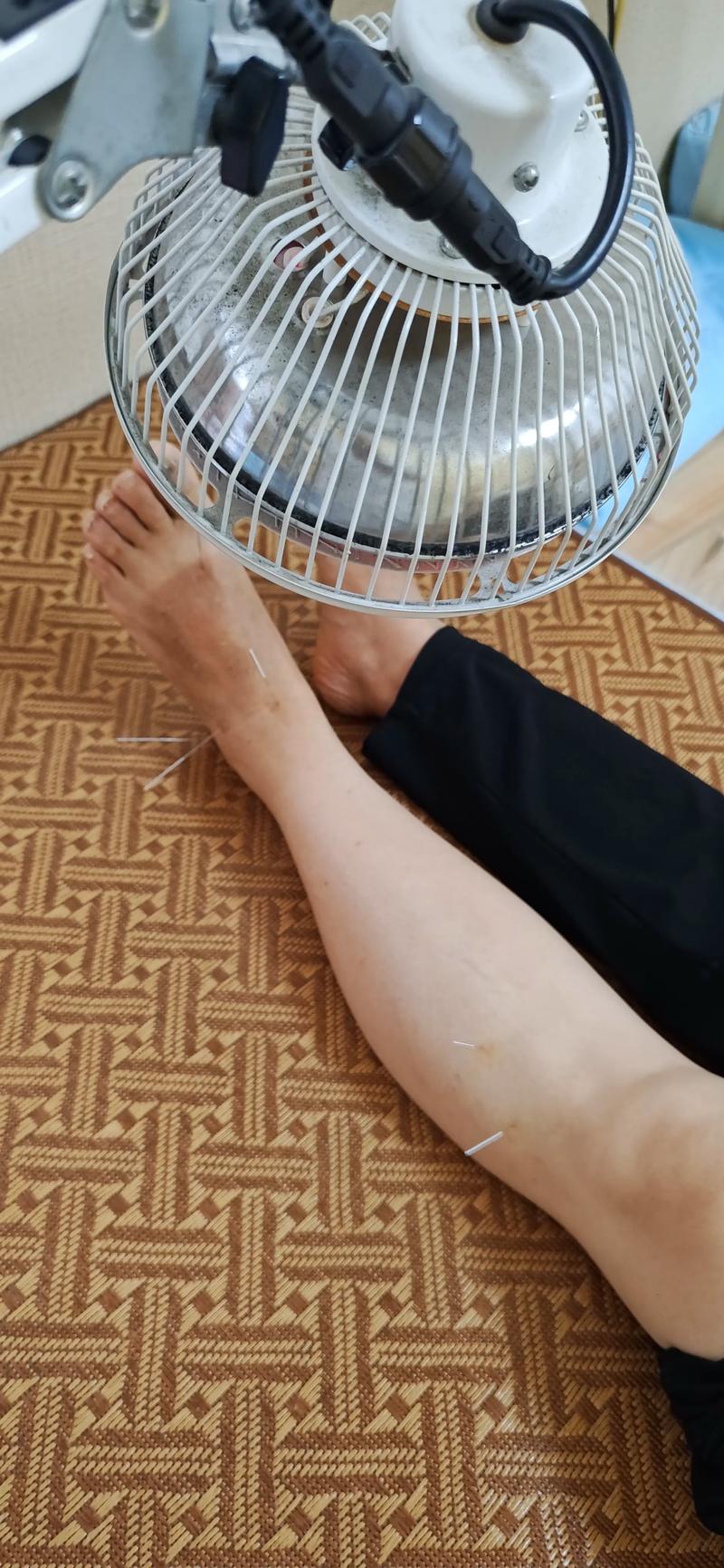 脖子扭伤可以针灸吗