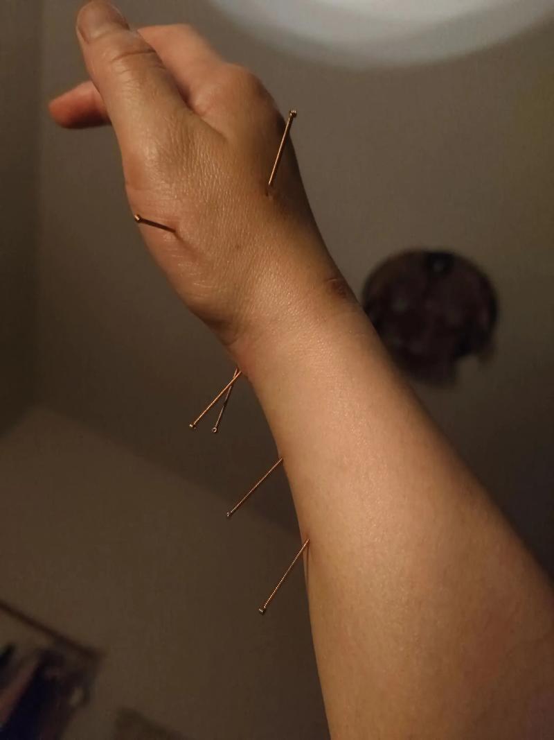 脖子扭伤可以针灸吗