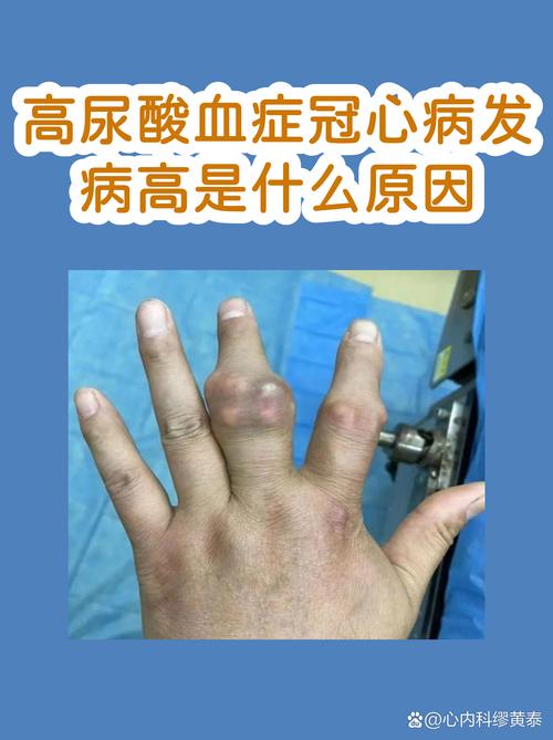 痛风发病率最高的城市