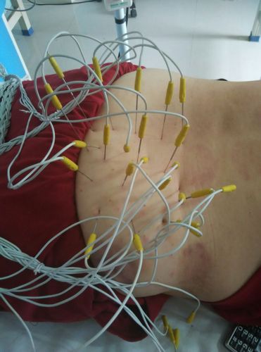 臀部针灸治疗什么病