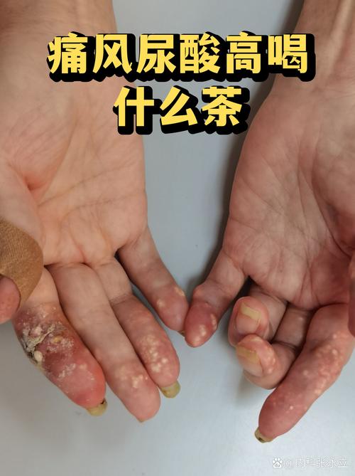 痛风可以喝蓝菊根茶吗