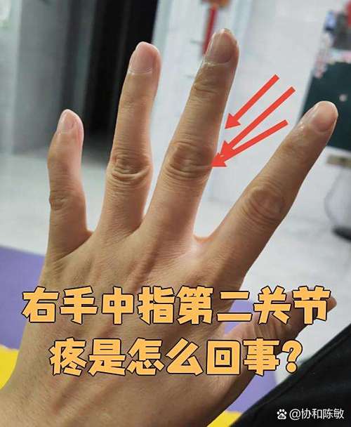 中指关节痛是不是痛风