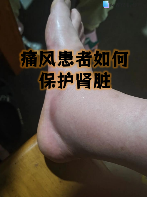 痛风跟肾结石有关系么