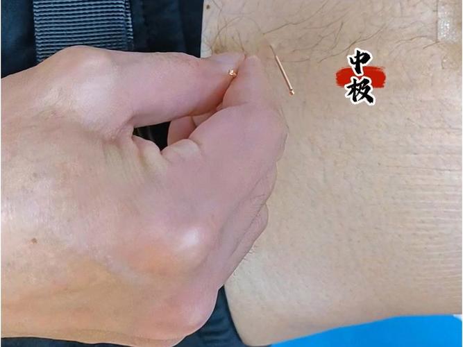 男人龟头可以针灸吗