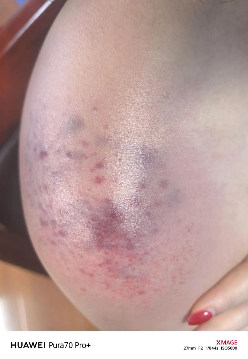 怎么样用艾灸治疗痛风