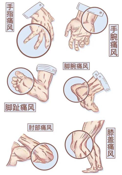 痛风从脚到膝盖是代表