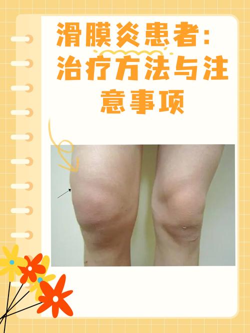 痛风性滑膜炎治疗方法