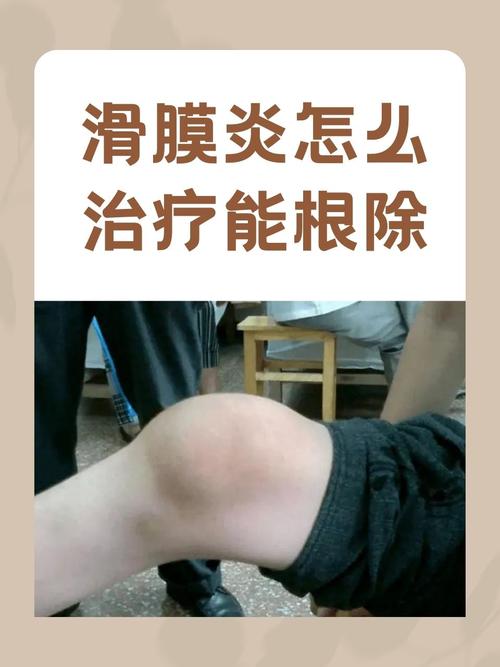 痛风性滑膜炎治疗方法