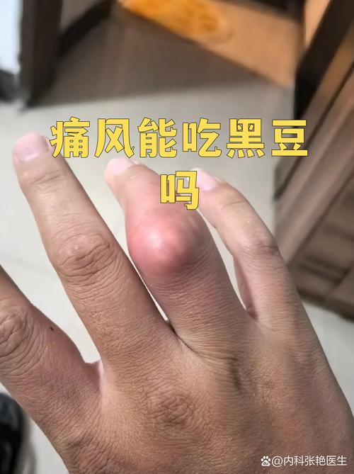 痛风豆类食品可以吃吗