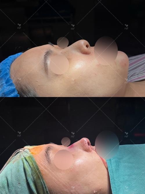 针灸隆鼻的效果 图